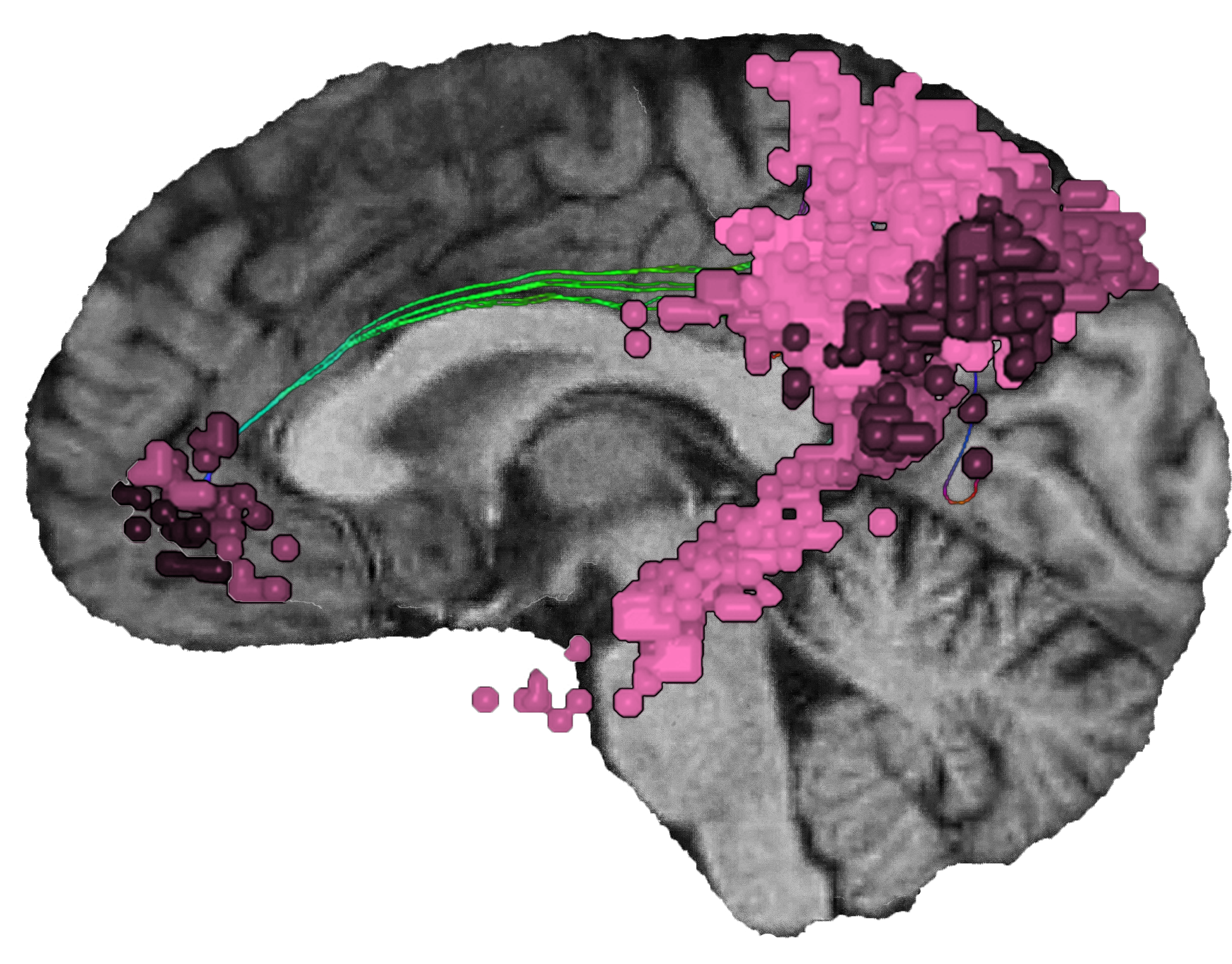 The Default Mode Network DMN 