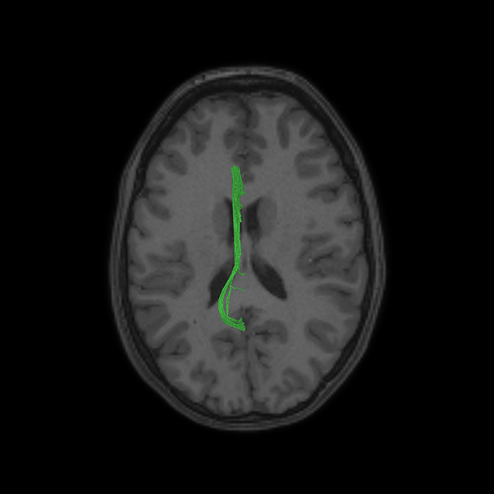 Default Mode Network - Connectome Guide