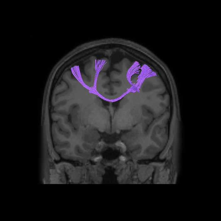 Dorsal Attention Network - Connectome Guide